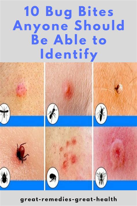 10 Bug Bites Anyone Should Be Able to Identify in 2020 (With images) | Bug bites, Identifying ...