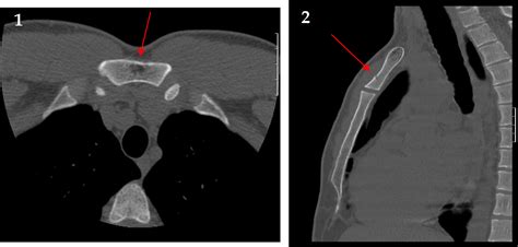 Figure 1 from Case report: Pathological fracture of the manubrium sternum of unknown aetiology ...