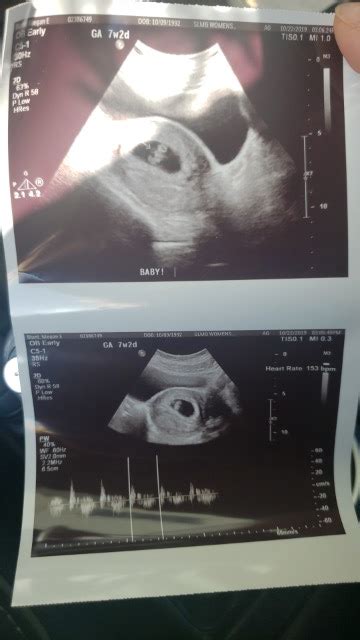 Second US, first was too early for fetal pole to be seen. Measuring perfectly. - Glow Community