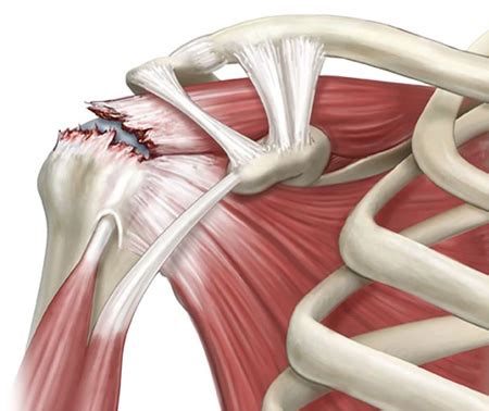 Arthroscopic Rotator Cuff Repair - Dr Lingaraju