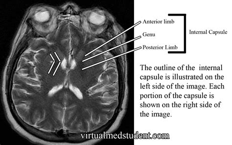 VirtualMedStudent.com || Internal Capsule