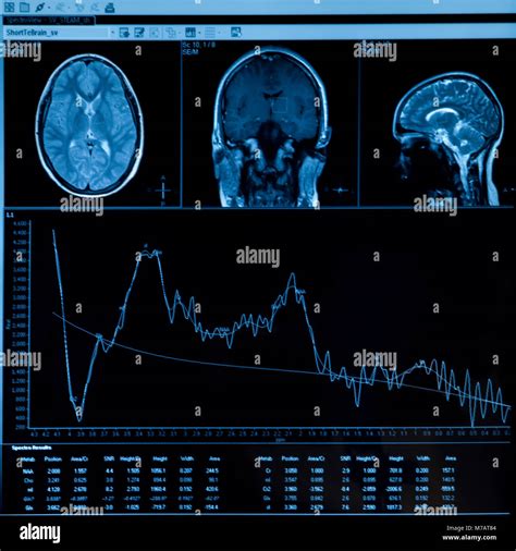 Close-up of MRI scan report Stock Photo - Alamy