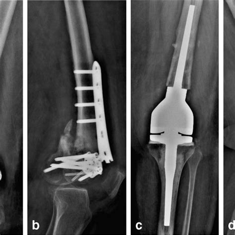 Post operative x-ray of femoral spacer. Note long segment of nail... | Download Scientific Diagram