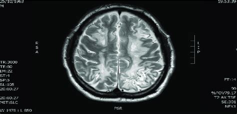 Showing diffuse White matter lesions on MRI of brain (T2 axial). | Download Scientific Diagram