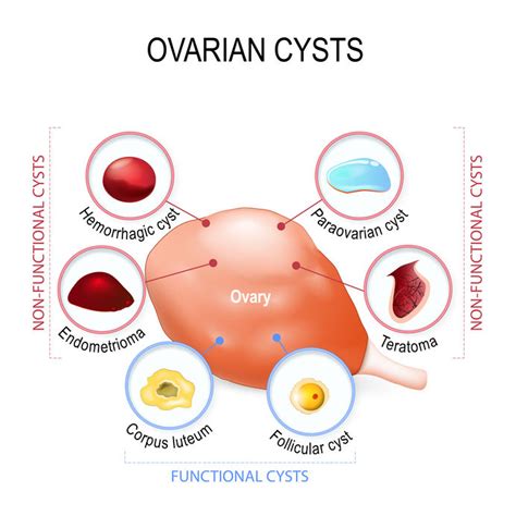 Ovarian Cysts – The Golden Lady