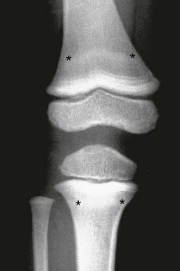 Metabolic Bone Disease | Radiology Key