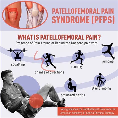 Patellofemoral Pain Syndrome: A Quick Reference —, 43% OFF