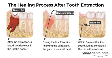 Tooth Extraction Aftercare (Instructions): The Dos & Don’ts