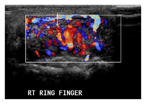 Synovial sarcoma. MRI (of the same patient as Figure 8). On T2W images... | Download Scientific ...