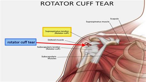 Rotator cuff tear symptoms, causes, diagnosis, prognosis and treatment