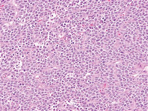 Synovial Sarcoma | Oncohema Key