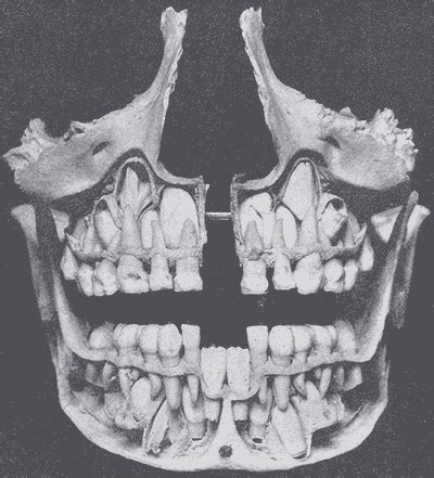 Anatomy of tooth eruption | Teeth art, Teeth eruption, Childs skull