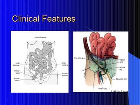 Femoral hernia: A challenging hernia!