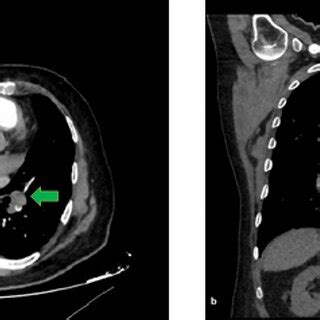 Computed tomography pulmonary angiography images of a 55-year-old... | Download Scientific Diagram