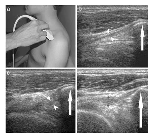 Structure of coracohumeral ligament | Semantic Scholar