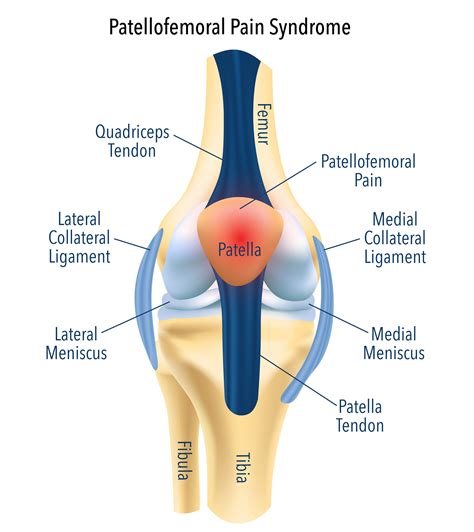 Patellofemoral Pain Syndrome