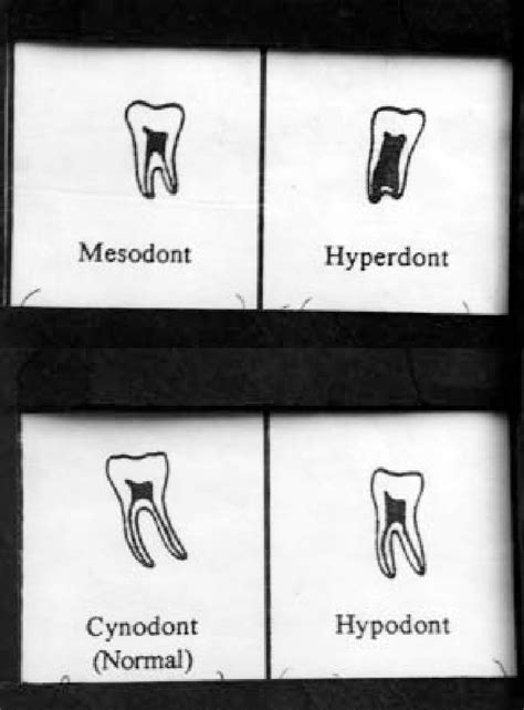 Taurodontism classified as Hypo, Mesio and Hyper type | Download Scientific Diagram