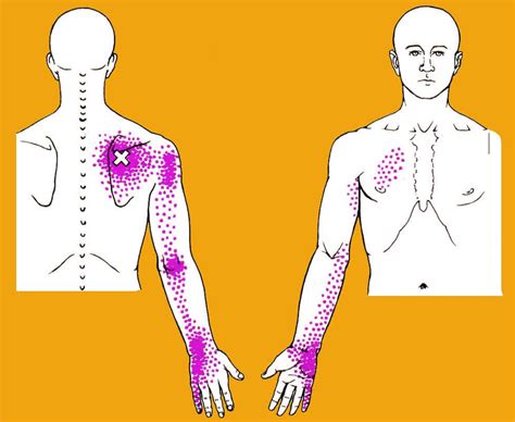 Chest Wall, Back and Thoracic Pain - Piedmont Physical Medicine & Rehabilitation, P.A.