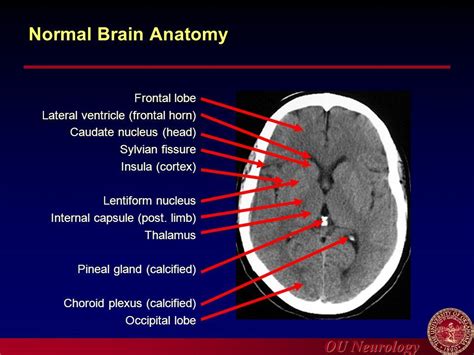 Normal Brain Ct Anatomy