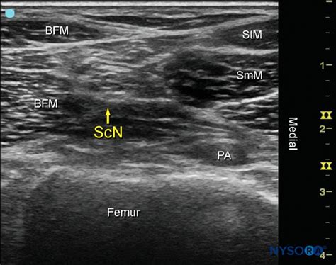 Sonoanatomy of the sciatic nerve (ScN) before its division. Shown are the ScN, superior and ...