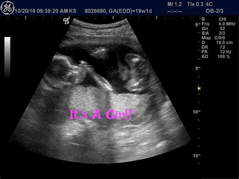 Ultrasound/Gender Reveal - 17 Weeks : r/BabyBumps