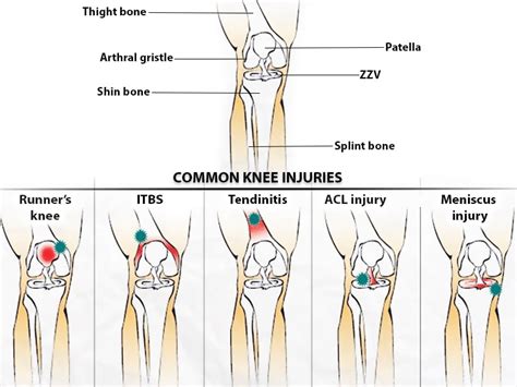 Knee Injuries NJ & NYC