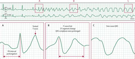 Sine Wave Hyperkalemia Ecg Changes