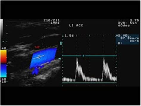 Peripheral vessels | 10.1 Peripheral arteries : Case 10.1.2 Vertebral artery and subclavian ...