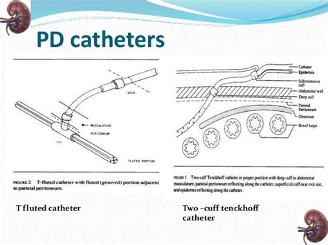 Peritoneal Dialysis Catheter Types