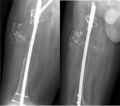 Right femoral X-ray of patient when he was referred to us | Download Scientific Diagram