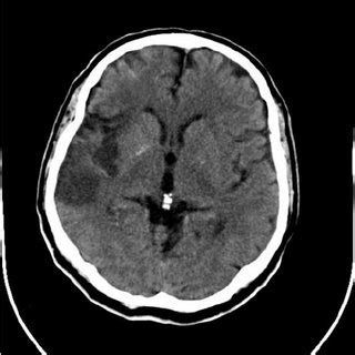 Ischemic stroke in the middle cerebral artery territory (magnetic... | Download Scientific Diagram