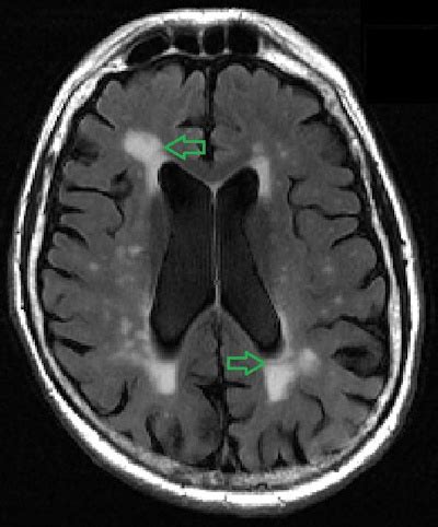 New calculator assesses cognitive decline on brain MRI