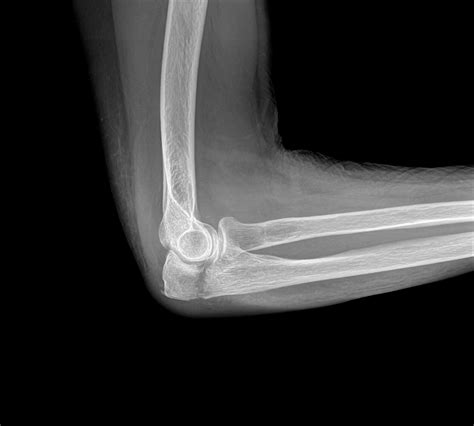 Olecranon Fracture Child