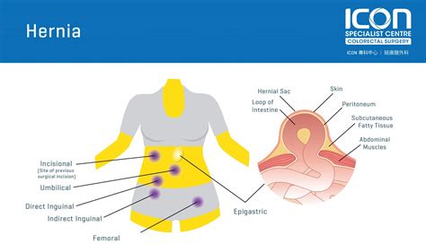 2024 Hernia Coding Changes - Pippy Brittney