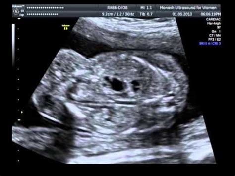 Trisomy 18 Ultrasound Markers