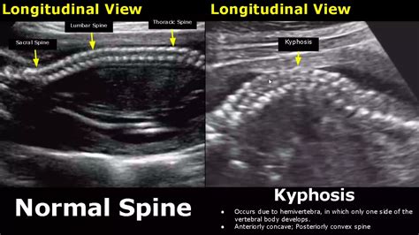 Fetal Spine Ultrasound Normal Vs Abnormal Image Appearances | Spinal Abnormalities | Obstetric ...