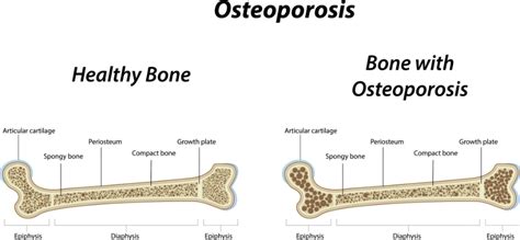 Metabolic Bone Disease – San Antonio Endocrinology & Diabetes Care