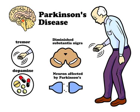 Parkinson's Disease Symptoms, Causes, Diagnosis & Treatment - HealthPulls