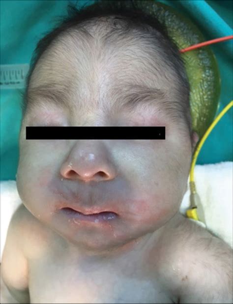 Trisomy 18, Edwards syndrome causes, symptoms, life expectancy & treatment