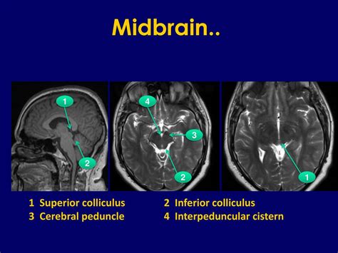 Inferior Colliculus Mri