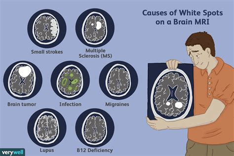 Spots on a Brain MRI: White Matter Hyperintensities