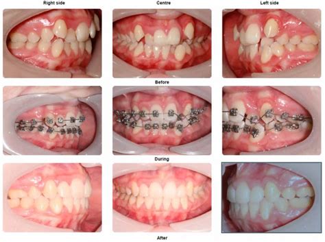 Braces Before and After Photo Gallery - orthodontics