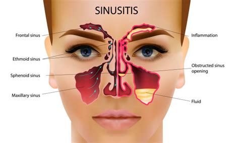 Normal Anatomy Of The Nose And Paranasal Sinuses | ubicaciondepersonas.cdmx.gob.mx