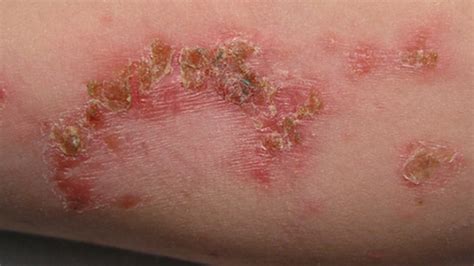 Skin Infection: Pictures, Causes and Treatments