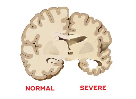 What causes dementia? - Queensland Brain Institute - University of Queensland