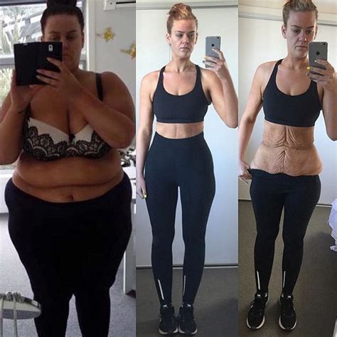 Makeup Artist Who Shared 194-Lb. Weight Loss on Social Media Gets Skin Surgery