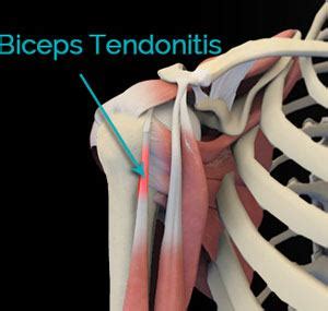 Biceps Tendonitis Cincinnati | Shoulder Pain Treatment West Chester | Dayton