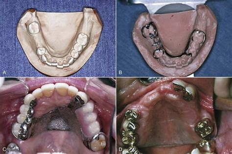 6: Rests and Rest Seats | Pocket Dentistry