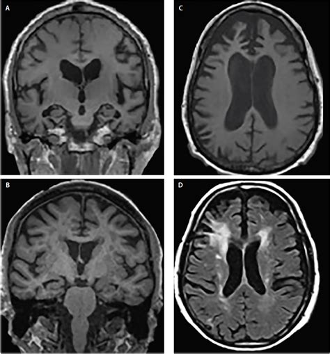 Brain Imaging in Differential Diagnosis of Dementia - Practical Neurology