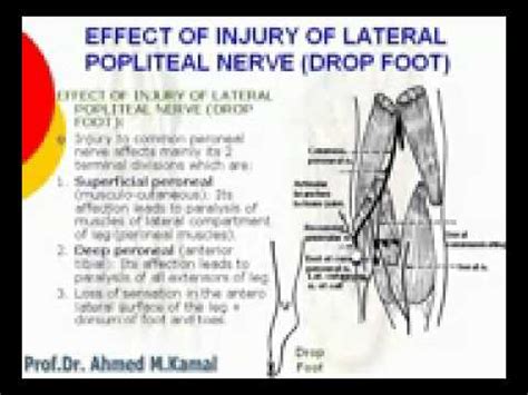 95 L Limb Injury of lateral popliteal nerve Azharmedicine com - YouTube